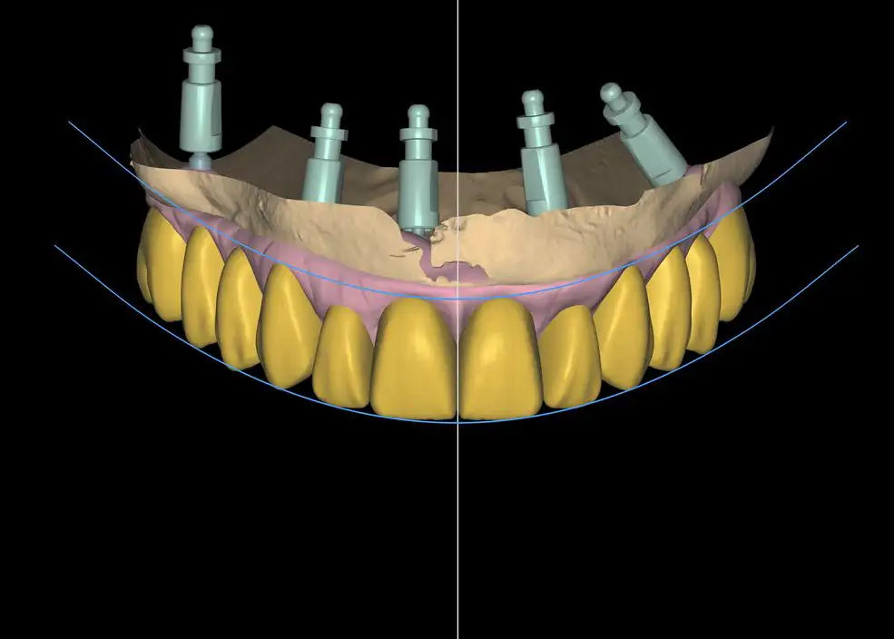 Žokļa 3D modelis ar implantiem un topošo protēzi