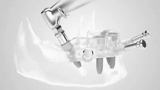 Implantu ievietošana žoklī pēc ķirurģiskā šablona