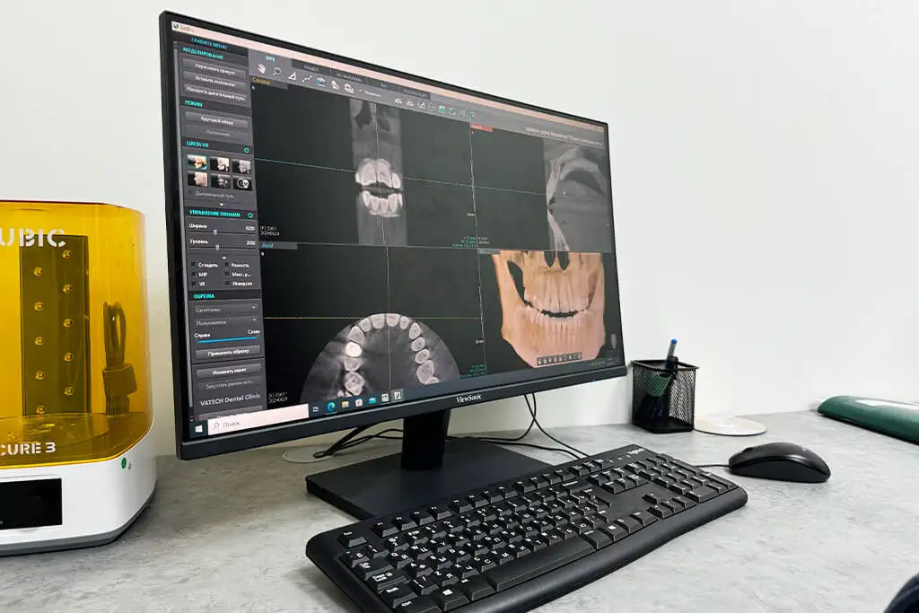 Žokļu datortomogrāfijas attēls monitorā diagnostikas kabinetā