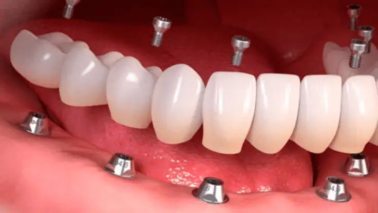 All-on-6 implantācija