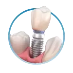 Dentālais implants ar kroni
