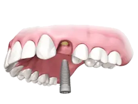 Kaulā ievietots implants zaudēta zoba vietā