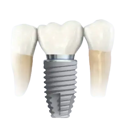 Viens implants ar kronīti starp diviem saviem zobiem