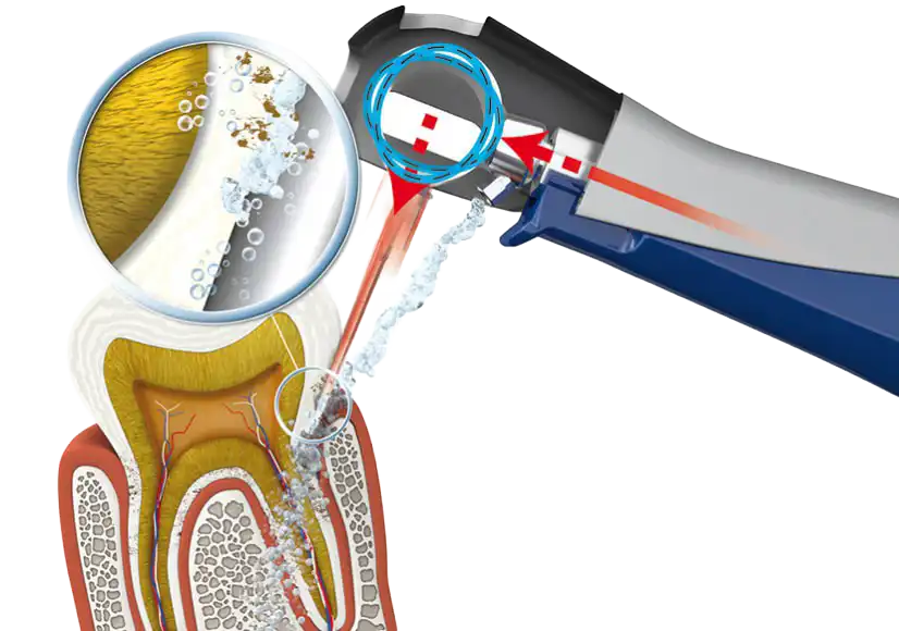 Periodonta kabatas apstrāde ar Vector