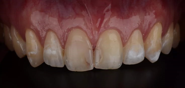 Prosthetic restoration of the six upper anterior teeth with E.max crowns