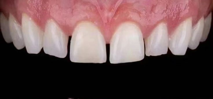 Dental restoration with implants and zirconium crowns