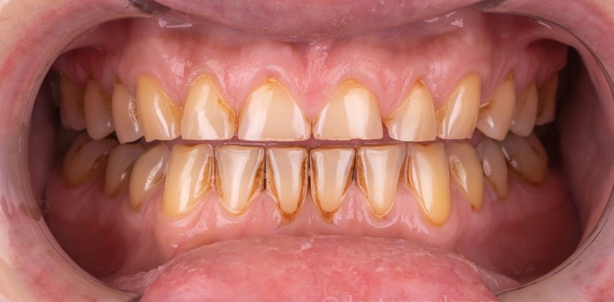 Prosthetic restoration of 4 chewing teeth with zirconium crowns