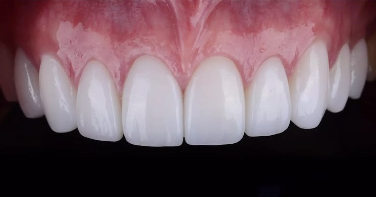 Prosthetic restoration of the six upper anterior teeth with E.max crowns