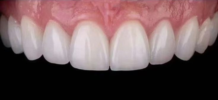 Dental restoration with implants and zirconium crowns
